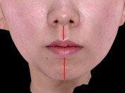 턱 우회전으로 인한 입술비대칭과 턱라인비대칭(매선요법)