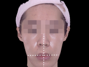 턱비대칭- 휜코 인중 입술